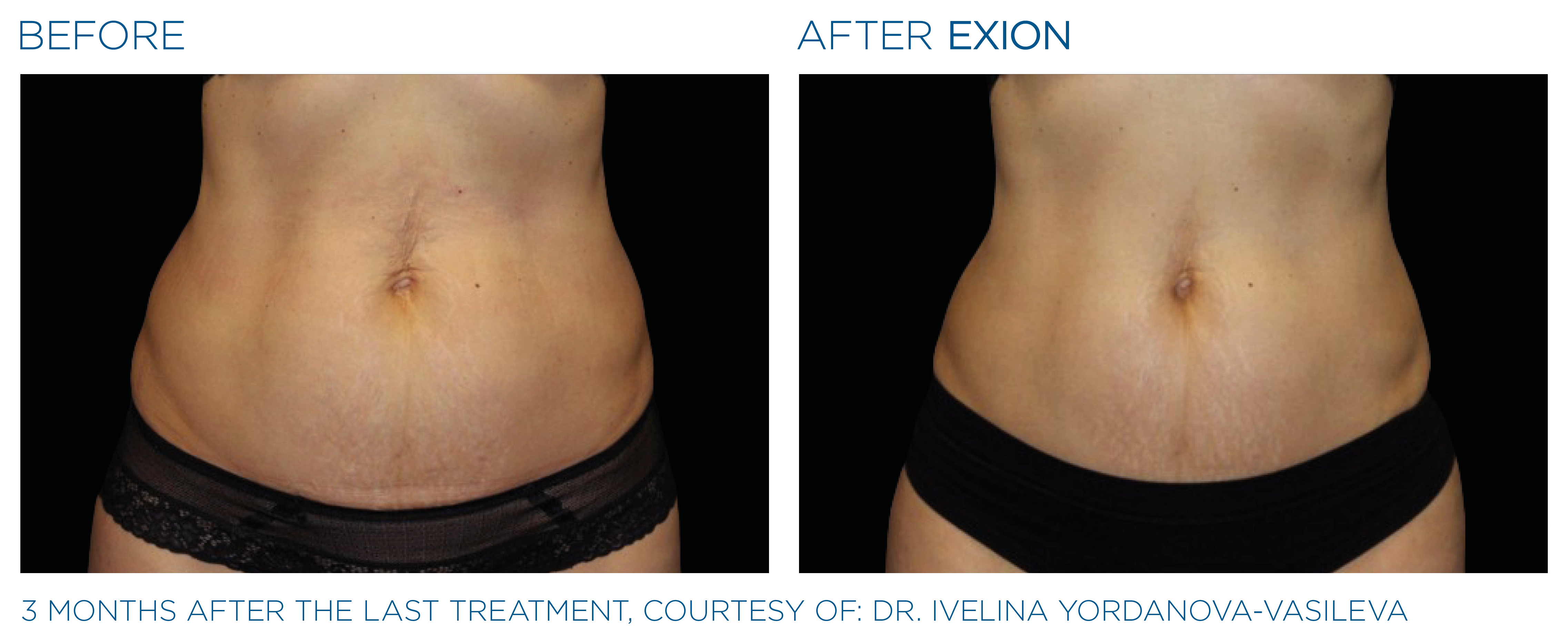 Exion Body before and after results, abdomen
