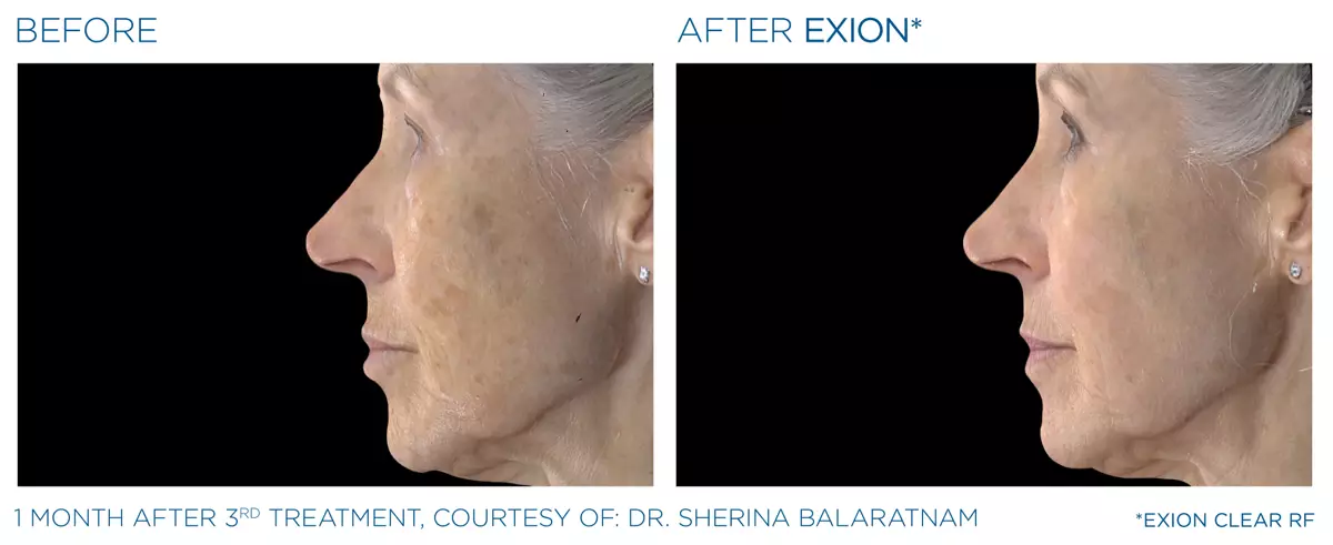 Exion treatment result